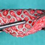 Griglie in titanio personalizzate con tecniche CAD/CAM per la rigenerazione di creste atrofiche