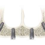 Riabilitazione di un’arcata superiore completa in una situazione di edentulia totale