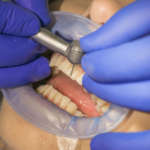 Proprietà ottiche e superficiali di disilicati e silicati rinforzati in zirconia DM_il-dentista-moderno_di-silicato-zirconia.jpg