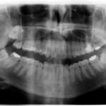 Come si valuta la difficoltà dell’intervento di estrazione dei terzi molari? Classificazioni a confronto e proposta di una classificazione comprensiva e semplificata (CSDS)