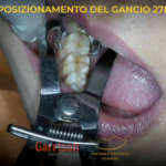 Matrici e anelli di nuova generazione per migliorare i restauri di II classe