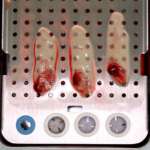 Platelet-rich fibrin: una opportunità in casi clinici specifici