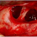 Note di anatomia chirurgica implantare. Il seno mascellare seno mascellare