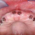 Note di anatomia chirurgica implantare: il settore anteriore del mascellare