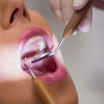 Corone in zirconia su elementi decidui DM_il-dentista-moderno_Chipping-delle-corone.jpg