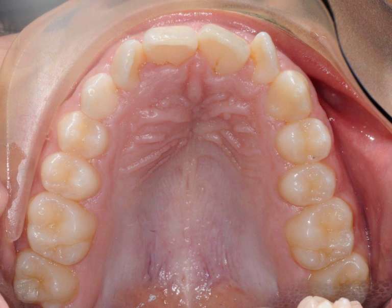 Problematiche diagnostiche dei canini inclusi: errori e complicanze