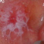 Strategie terapeutiche nel lichen planus orale oltre la farmacologia convenzionale