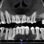 Radiologia in endodonzia: come migliorare la terapia