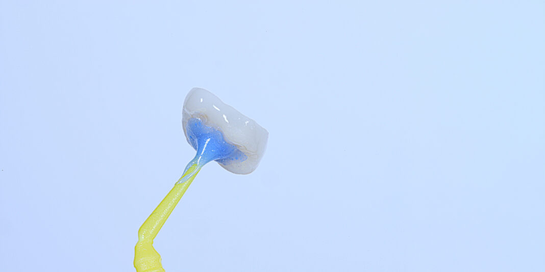 Occlusal,Laminate,Treatment,Known,As,Inlay,,Onlay,,And,Overlay,In Adesivi universali