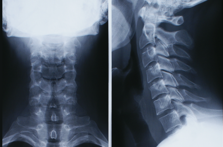 Un'artrosi di natura professionale