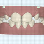 Protocollo integrato Digital Smile Design e Invisalign: una rivoluzione nel workflow digitale case report