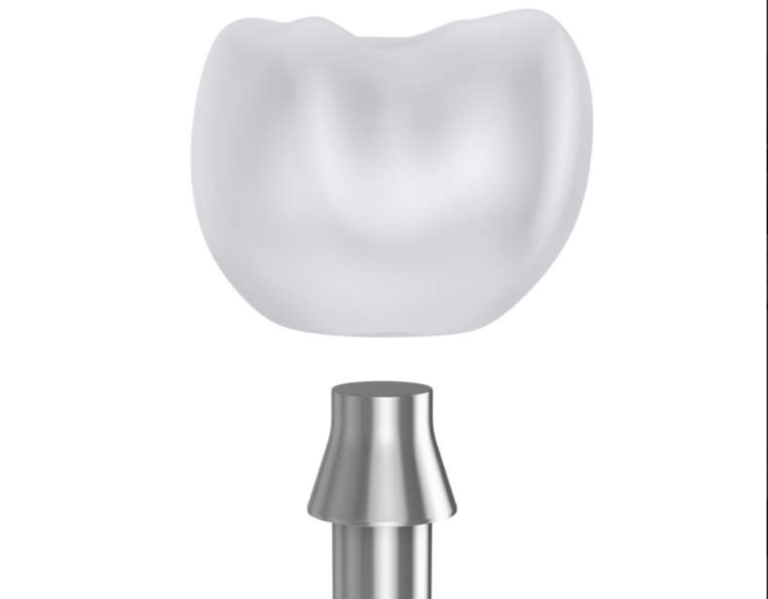 Implantologia immediata in regione molare