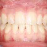 Approccio Surgery First alle malocclusioni dentoscheletriche: una nuova metodica che riduce i tempi di trattamento