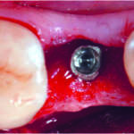 Management tissutale perimplantare con l’utilizzo di una matrice tridimensionale di derivazione suina