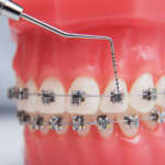 Decalcificazione dello smalto in pazienti ortodontici: prevenzione, trattamento e fattori di rischio Complicanze ortodontiche e teleortodonzia durante la pandemia Covid-19