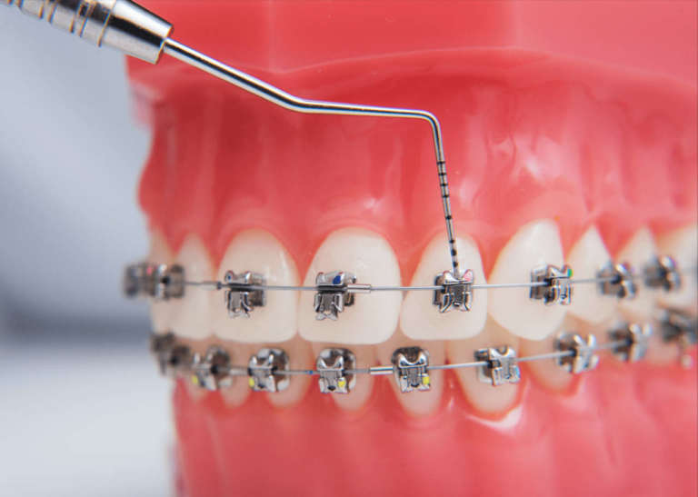Complicanze ortodontiche e teleortodonzia durante la pandemia di Covid-19