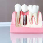 Percezione del paziente delle tempistiche di carico implantare DM_il dentista moderno_Split Crest Technique con impianti immediati