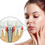 Stabilità primaria e secondaria di impianti autofilettanti e non autofilettanti DM_il-dentista-moderno_impianti_implantologia_filettatura_stabilità primaria