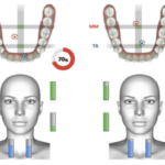 Effetti scheletrici e posturali della terapia elastodontica Esame occlusale con BTS-TMjoint