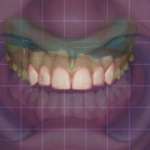 Faccette in composito da flusso di lavoro digitale