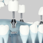 Significato clinico del valore ISQ in implantologia isq_stabilità implantare_