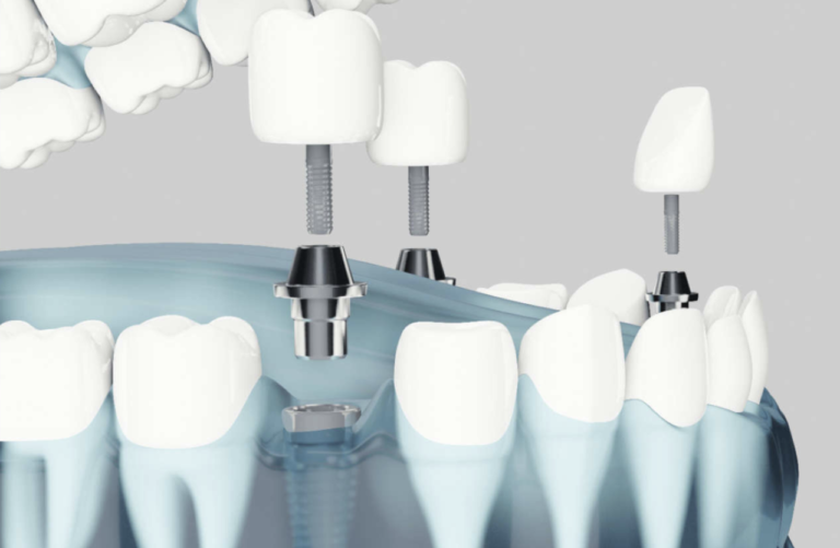 Significato clinico del valore ISQ in implantologia
