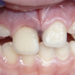 Il reimpianto, le lussazioni e le loro complicanze. Aspetti peculiari della traumatologia dentaria anche in ambito forense