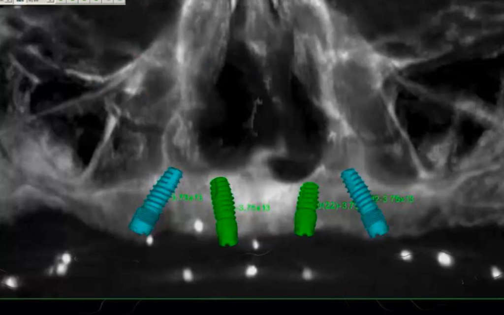 Pianificazione implantare del mascellare superiore
