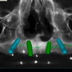 Riabilitazione bimascellare a carico immediato. Case report Pianificazione implantare del mascellare superiore