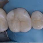 Restauri diretti o indiretti: quale riabilitazione per gli elementi vitali nei settori posteriori?