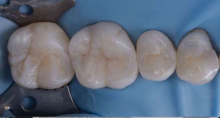 Restauri diretti o indiretti: quale riabilitazione per gli elementi vitali nei settori posteriori