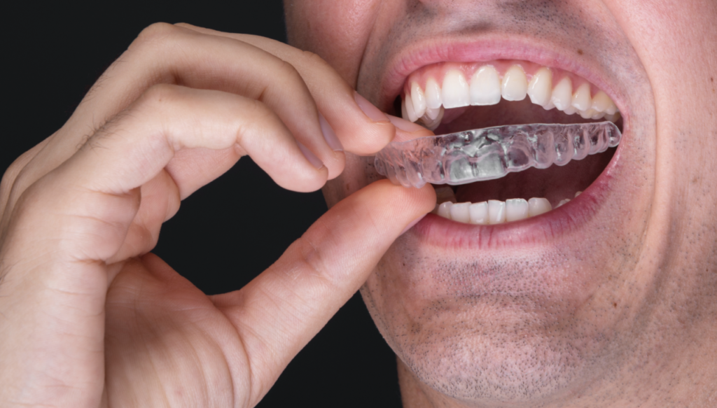 DM_il dentista moderno_clear aligner