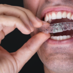 Trattamento dell’open bite con clear aligner DM_il dentista moderno_clear aligner