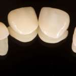 Faccette in laminato di porcellana: sopravvivenza e complicazioni a lungo termine