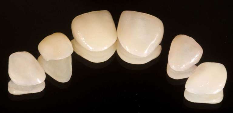 Faccette in laminato di porcellana: sopravvivenza e complicazioni a lungo termine