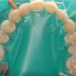 Riabilitazione adesiva minimamente invasiva di arcate con estesa usura dentale