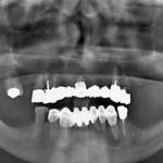 Nuovi materiali protesici nel carico immediato con impianti zigomatici