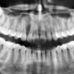 I tumori odontogeni: nuove entità e classificazioni