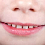 Alterazioni di sviluppo dello smalto nel nato pretermine DM_IL-DENTISTA-MODERNO_DIFETTI-DELLO-SMALTO.jpg