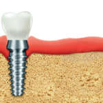 Risposta dei tessuti molli a impianto immediato e ridge preservation DM_Il-dentista-moderno_impianti-post-estrattivi