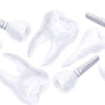 Fattori di rischio di fallimento implantare DM_il dentista moderno_fallimento implantare