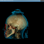 Valutazione delle caratteristiche scheletriche facciali mediante una metodica radiation free