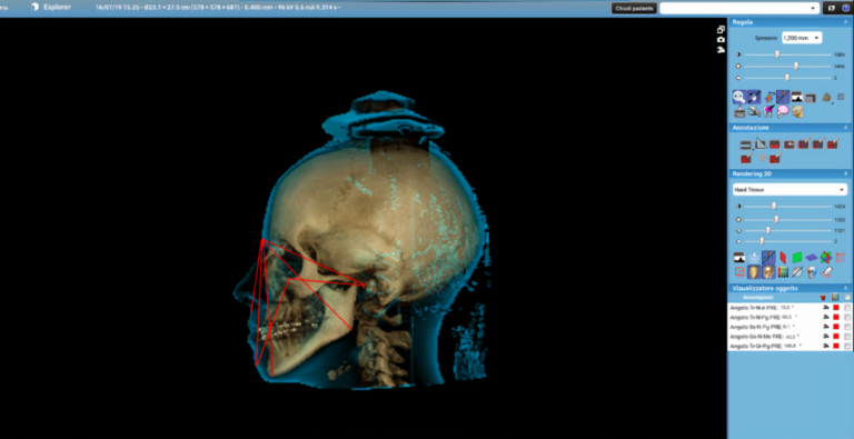 Valutazione delle caratteristiche scheletriche facciali mediante una metodica radiation free
