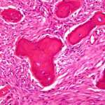 Un caso di fibroma ossificante gengivale