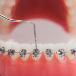 Validità clinica e di laboratorio degli adesivi ortodontici monocomponente DM_il-dentista-moderno_Validità-clinica-e-di-laboratorio-degli-adesivi-ortodontici-monocomponente.