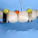 Riabilitazione implantare guidata di tipo All-on-Four®: caso clinico con proposta di protocollo EMG