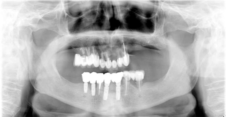 Riabilitazione implantare guidata di tipo All-on-Four®: caso clinico con proposta di protocollo EMG
