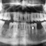 Gestione di pazienti in terapia con farmaci antiriassorbitivi