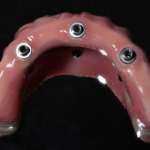 Riabilitazione mandibolare a carico immediato con sistema Trefoil. Caso clinico con follow up a tre anni