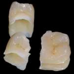 Opzioni di trattamento minimamente invasive in protesi fissa